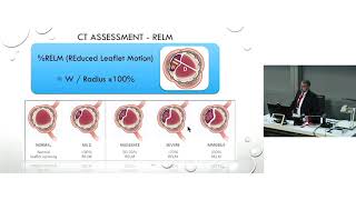 Leaflet Thrombosis in TAVI – Prof Greg Scalia