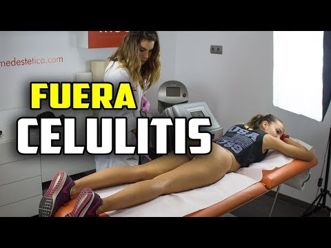 Eliminar celulitis con Ultracavitacion Eliminar celulitis con Ultracavitacion