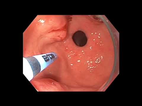 Żołądek arbuzowaty (GAVE) - koagulacja argonowa (APC) i opaskowanie