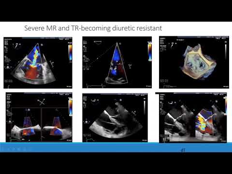 Transcatheter Therapies for the Tricuspid Valve, October 2, 2020