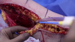 We Removed 800cc of Fat from Her Arms—Here’s the Shocking Result (Arm Lift Procedure)