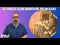 SO MUCH SKIN REMOVED FROM PATIENTS EAR CANAL EP945