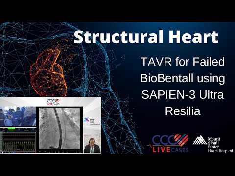 TAVR for Failed BioBentall using SAPIEN-3 Ultra Resilia