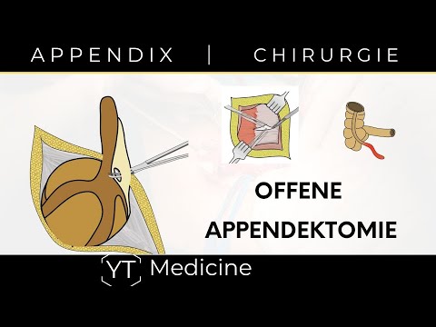 Offene Appendektomie