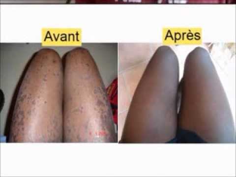 comment traiter une carence en vitamine d