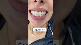 7 meses usando invisalign