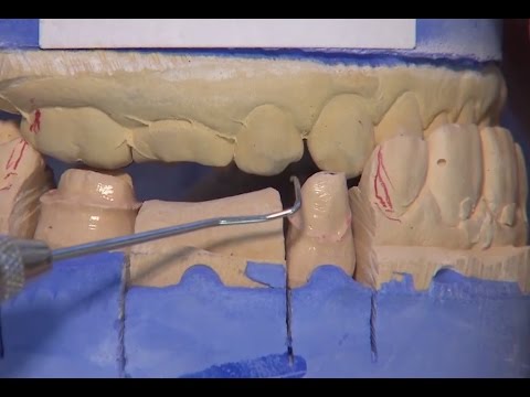 Case of the Week #86: Monolithic Zirconia Precision