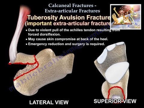 Calcaneal Fractures Extra articular Fractures - Everything You Need To Know - Dr. Nabil Ebraheim