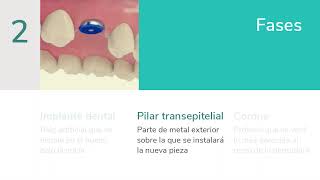 Dudas habituales y fases en los implantes dentales - Clínica Dental Rafael Menéndez