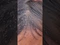 Picking a thousand of lice on hair - How to get rid of lice