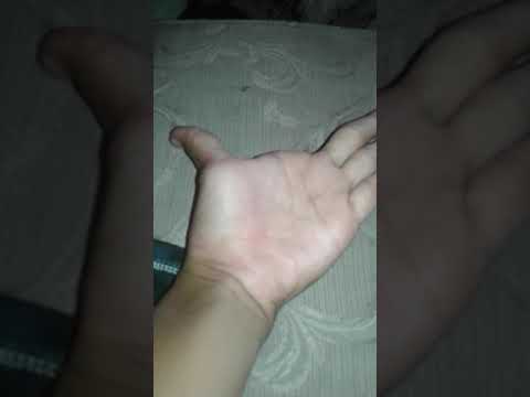 Na kagat ang kanyang kuko paggamot Tips Dermatologist upang gamutin ang kuko halamang-singaw