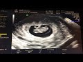 [8 Weeks Pregnant] First 3D Ultrasound with Heartbeat