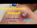 Painful large abscess infected with Proteus Mirabilis drained.Cyst contents start at 14:10. Amazing!