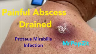 Painful large abscess infected with Proteus Mirabilis drained.Cyst contents start at 14:10. Amazing!