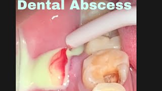 Dental Abscess Drain