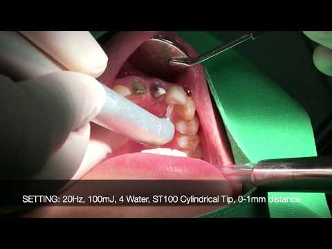 Zirconia Crown Removal with LIGHTMED's SAPPHIRE Laser