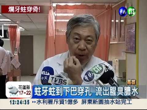 乳牙蛀到骨頭溶解 下巴穿孔流膿!