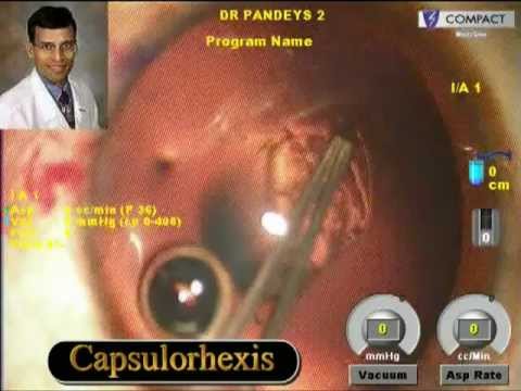 Managing Cataract with Astigmatism