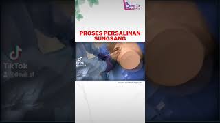 Download lagu Proses Persalinan Sungsang mp3