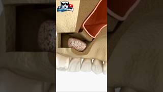 Sinus lift surgery #shorts #dentist #dentistry #sinus #implant #surgery #teeth