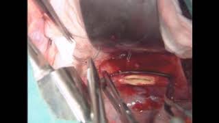 Download Lagu thoracofemoral aortic bypass Thumbnail