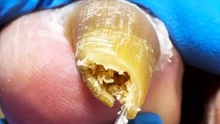 Roll The Onychomycosis Into A Circle To Remove Impurities!【Xue Yidao】