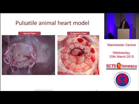 FORTIS Transcatheter Mitral Valve Implantation