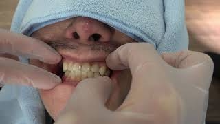 前歯の歯並び15　セラミック矯正で即日18歯を劇的に美しくサムネイル