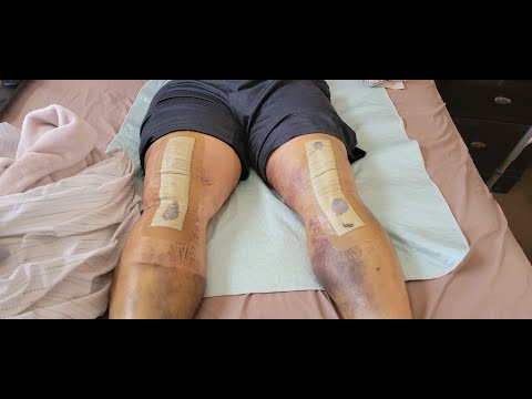 The Truth, Total Knee Replacement Bilateral 12 days Post Operation TKR Sports Recovery Pain DR Lies