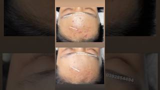 Before & After Acne Care – Performed by Lâm  #shorts