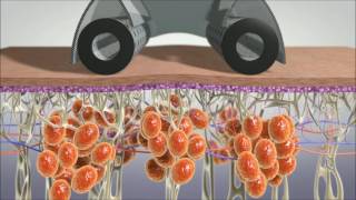 Download the video "Icoone Laser"