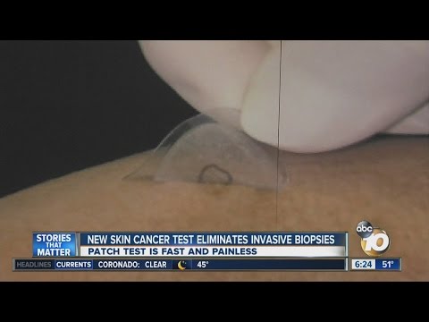 New skin cancer 'patch test' eliminates invasive biopsies