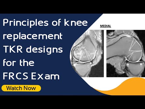 Principios de los diseños de reemplazo de rodilla