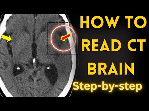 "How to Read a CT Brain | Basics of Head CT Interpretation"