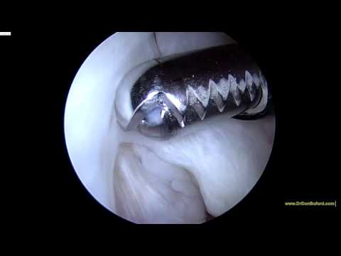 DM L bursal sided rotator cuff tear 42516 Video