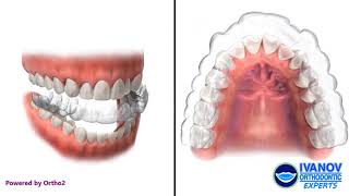 How Clear Aligners Invisalign Braces Work