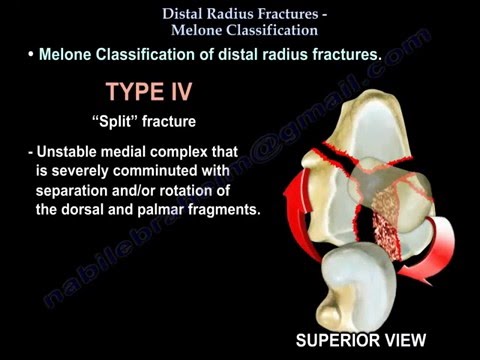 Distal Radius Fracture   Melone Classification - Everything You Need To Know - Dr. Nabil Ebraheim