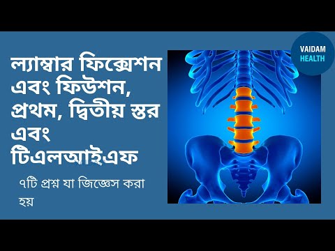 ল্যাম্বার ফিক্সেশন এবং ফিউশন- প্রায়শই জিজ্ঞাসিত প্রশ্ন