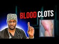 Blood Clot Dangers Learn The Warning Signs