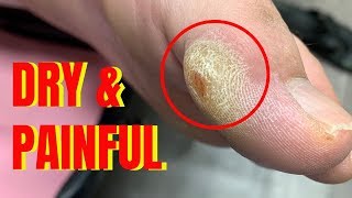 SUPER Dry & Painful Calluses Removal