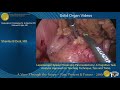 Laparoscopic Spleen Preserving Pancreatectomy