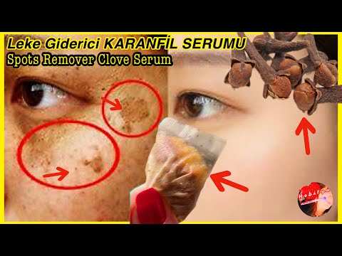 , title : 'Miracle Clove Face Serum! Put Clove and Lemon Peel Into Tea Bags, Eliminate Spots in 30 Minutes'