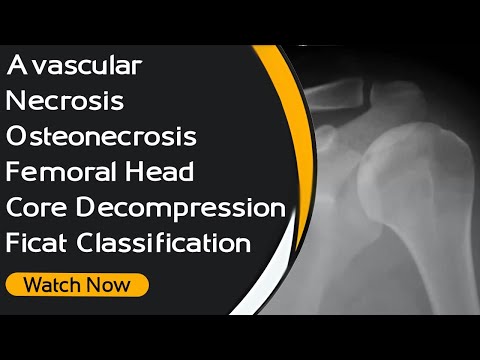 Avascular Necrosis