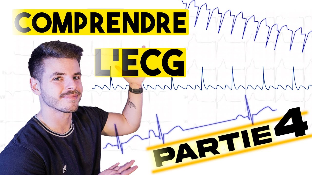 Lecture d'un ECG : troubles du rythme supraventriculaires (partie4)
