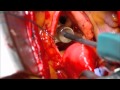 Minimally Invasive AVR With Carpentier Edwards Perimount Ease Through Upper Ministernotomy
