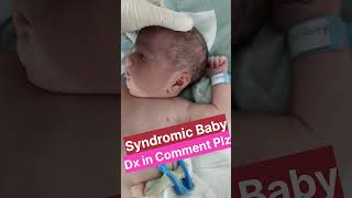 Download lagu Noonan Syndrome  #syndromes #Nicu #shorts mp3