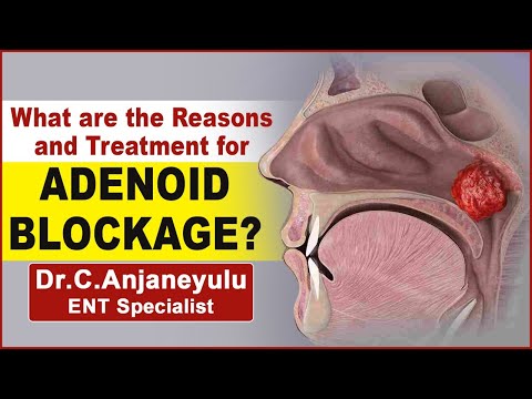Treatment Of Infected Adenoids In Children | Dr Chava Anjaneyulu ENT Expert | Socialpost Healthcare