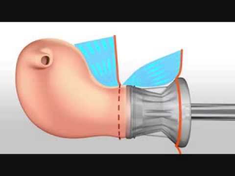 Richard Wolf SecuFix Uterus Manipulator