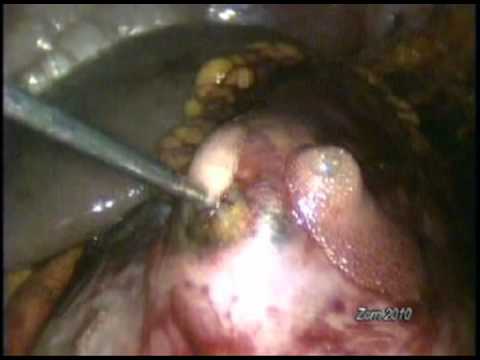 Renal Mass Thermal Ablation - Kidney Cancer Treatment