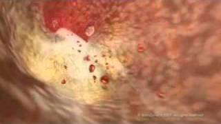 How cholesterol clogs your arteries that causes atherosclerosis 1